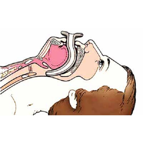 TUBO OROFARINGEO FORMED